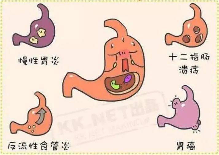 幽门螺杆菌感染患者,多数无症状,但几乎均存在慢性活动性胃炎,即慢性