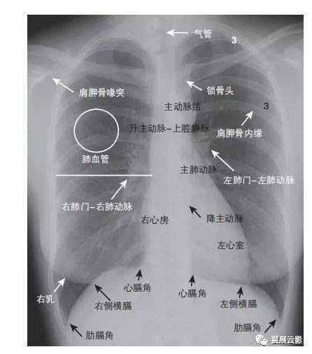 正常的胸部正位片 图2-1显示x线正位胸片可见的一些正常的解剖特征.