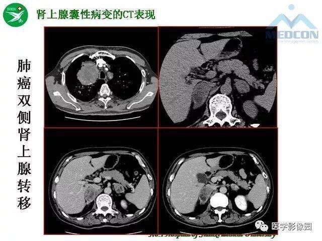 李健丁教授:肾上腺囊性病变的msct表现