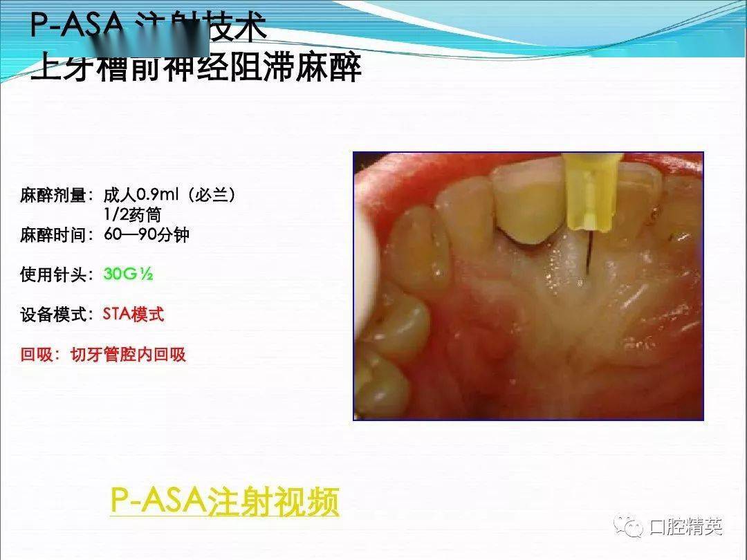 如何实现安全舒适口腔麻醉