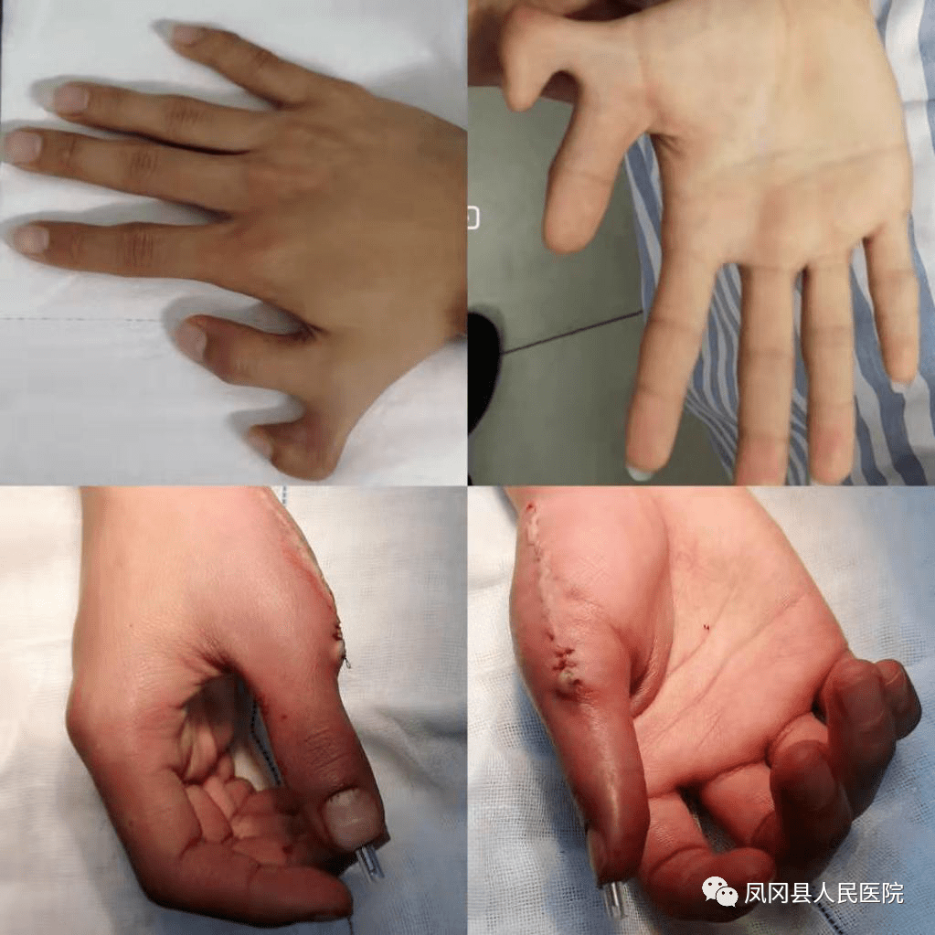 尤其是边缘性多指并指易导致手指发育弯曲畸形,建议早期手术,中央型多