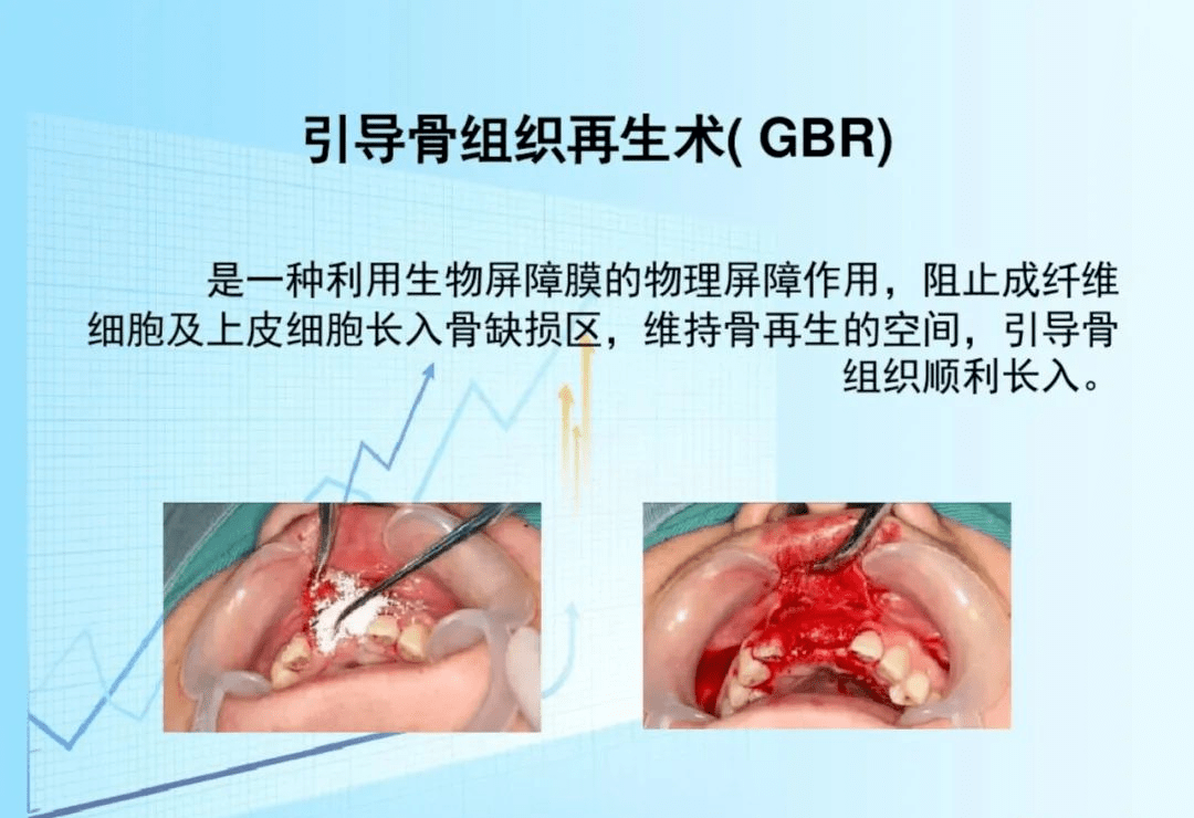 骨增量技术之上颌窦提升术