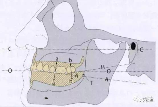 从矢状面观察下颌牙槽嵴,或多或少的呈现出向下方凹陷的曲线,若在该