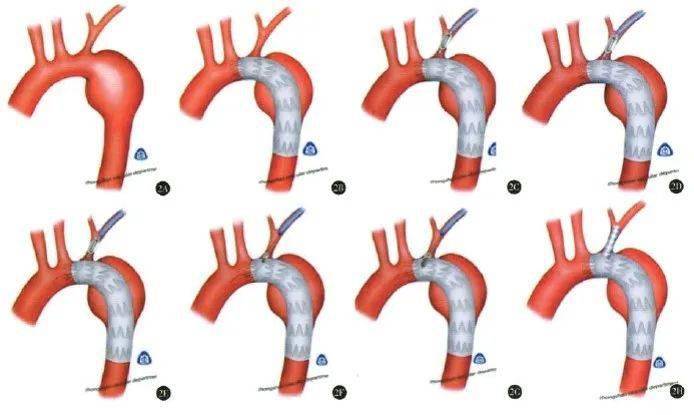 如何提高ankura胸主动脉支架穿刺针原位开窗成功率二