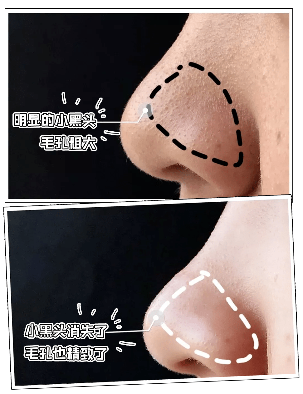 毛孔吸盘来了和10年粗大黑头说拜拜太爽了