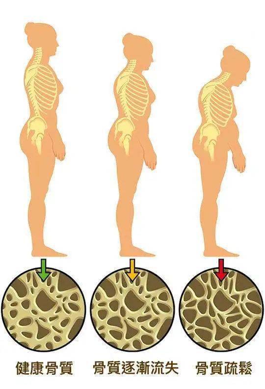 中老年女性骨质疏松问题严重!50岁以上人群须警惕!