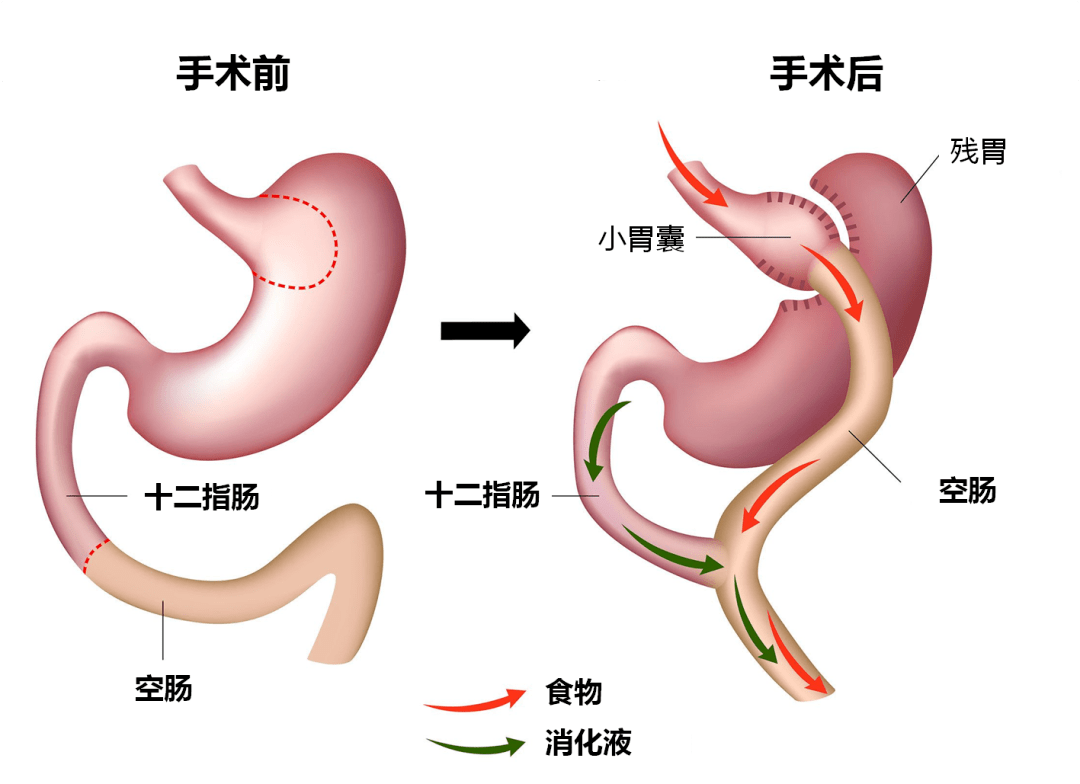 ▽胃转流手术(rygb手术 ) ▽