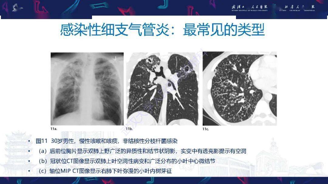 精彩推荐 细支气管炎影像诊断