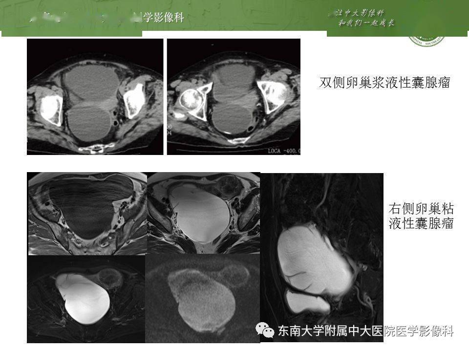 卵巢囊肿蒂扭转影像表现