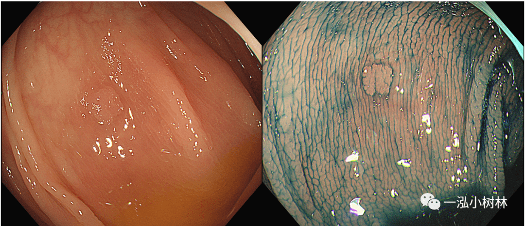 结肠息肉图谱