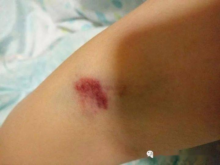耐心指导按压要点,按压部位不当,造成拔针后皮下瘀血,血肿