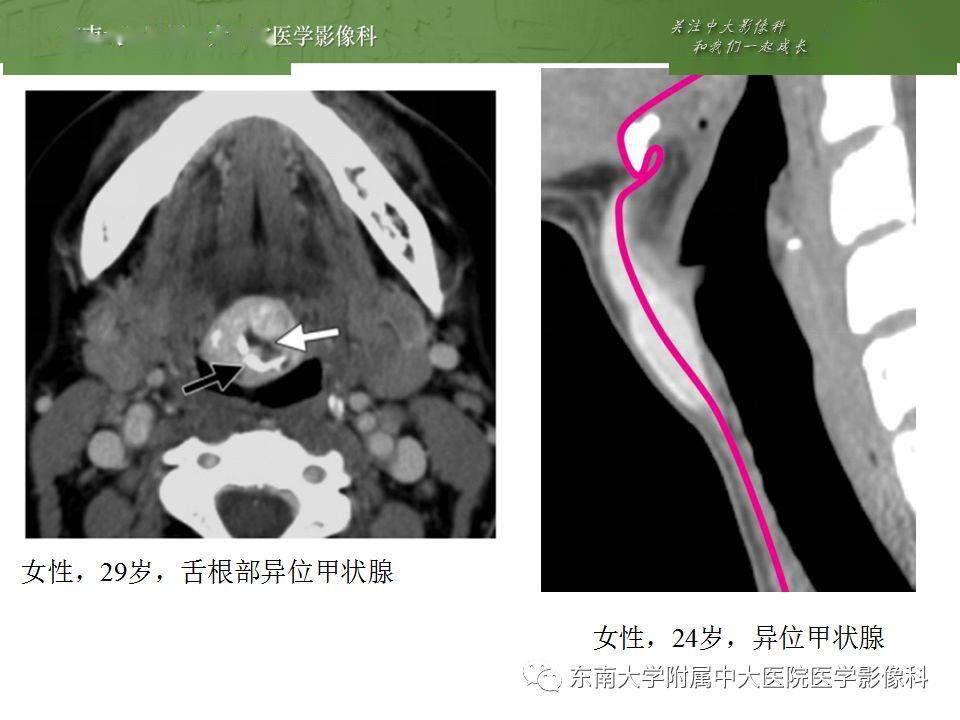 ct 增强 编辑/校对:郑孝飞 病例结果: 病例1:异位甲状腺;病例2:甲状舌