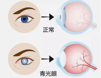广东师奶经常敲打这个部位,时间长了眼睛肿胀,疼痛,恶心呕吐