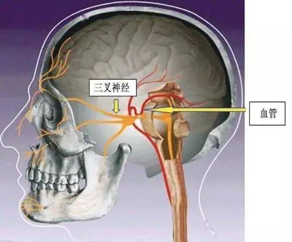 图三 三叉神经与血管关系透视图 此病多发生在40岁以后,中老年人中