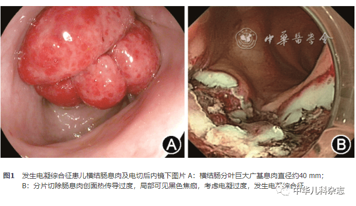 临床研究与实践儿童肠息肉术后电凝综合征的临床特征及危险因素分析