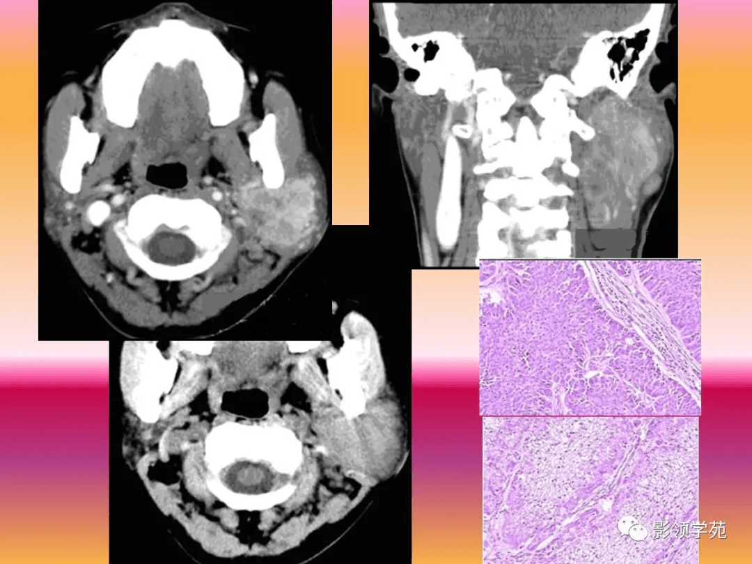 腮腺疾病的ct诊断与鉴别诊断