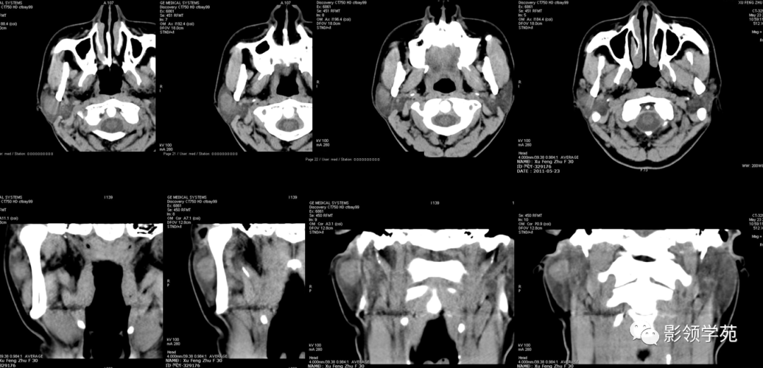 病例2:女,30岁,发现右耳垂下肿物9月 病理:混合瘤