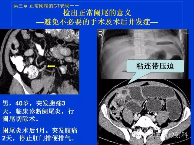 全面讲解 | 正常阑尾和阑尾炎的ct表现