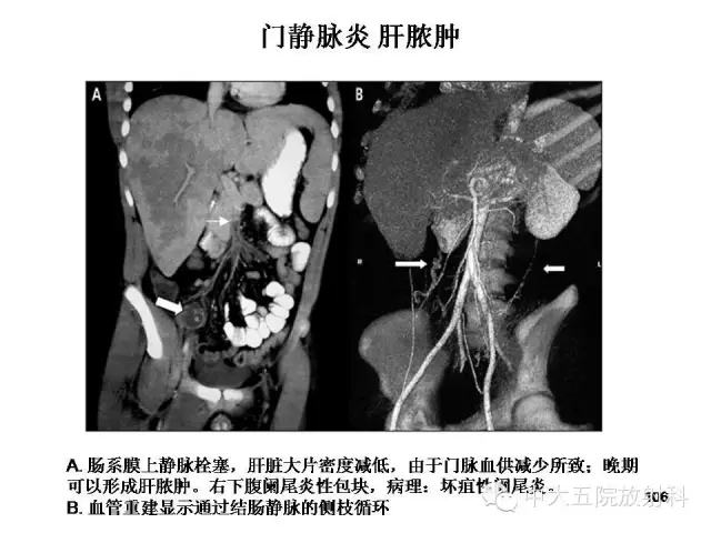 全面讲解 | 正常阑尾和阑尾炎的ct表现