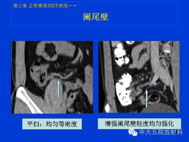 全面讲解 | 正常阑尾和阑尾炎的ct表现