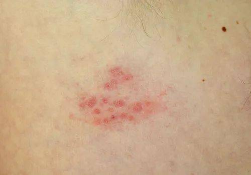 猩红热的皮疹多在发热第二天出现,最先出现在  颈部,腋下和腹股沟等处