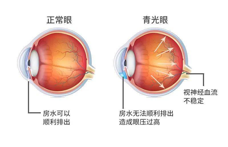 青光眼是指由于病理性眼内压升高导致视神经损伤,视野缺损,使视力