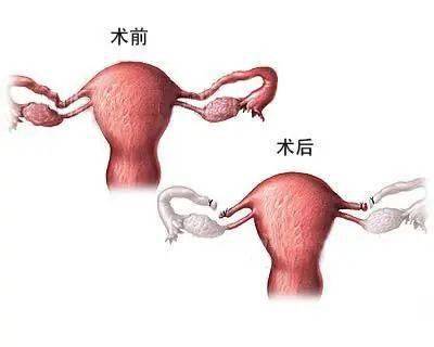 输卵管结扎术:结扎后使积水不能流入子宫腔,达到和输卵管栓塞一样的