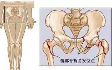 我院骨伤科成功为两名近百岁高龄股骨粗隆间骨折患者实施pfna微创内