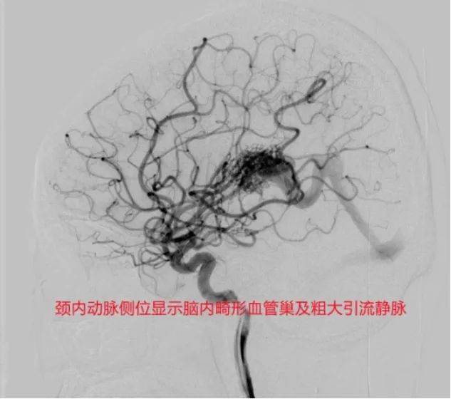 进一步磁共振检查显示脑深部血管畸形,建议转入上级医院治疗