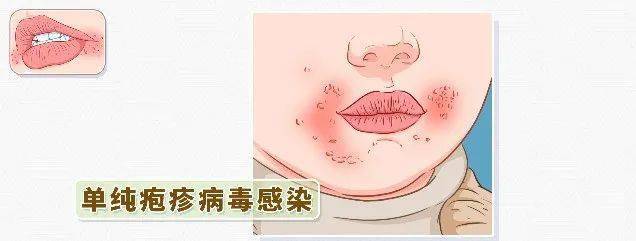 『 病毒感染 』 病毒感染也会导致口角炎,比如单纯疱疹病毒感染,单纯