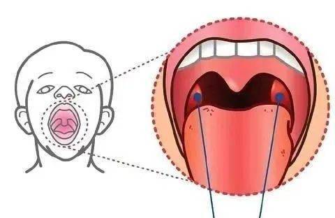 腭扁桃体 知多少?