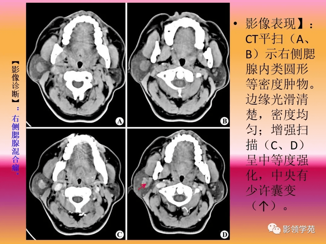 腮腺疾病的ct诊断与鉴别诊断