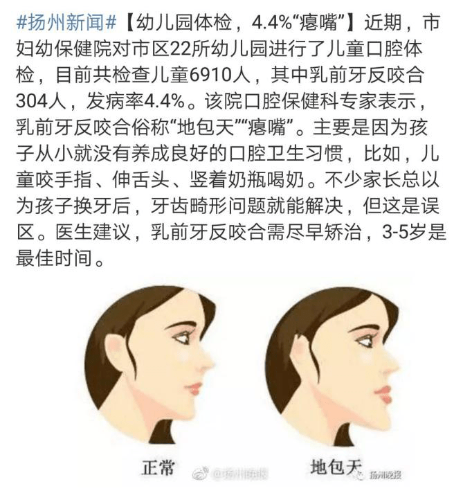 4%的幼儿存在"瘪嘴"现象.