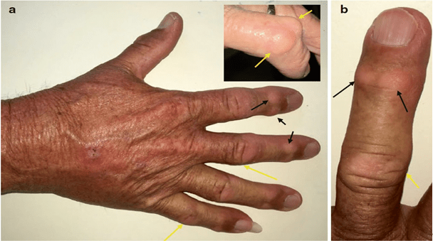 手骨关节炎的两种不同结节,如何区分?