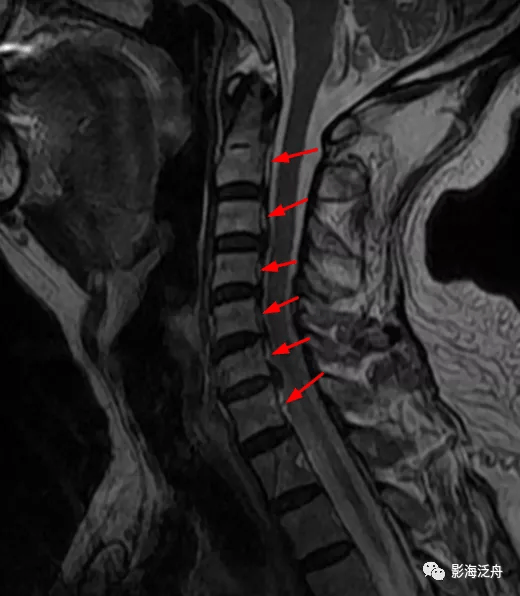 典型病例——颈椎后纵韧带钙化(mr)