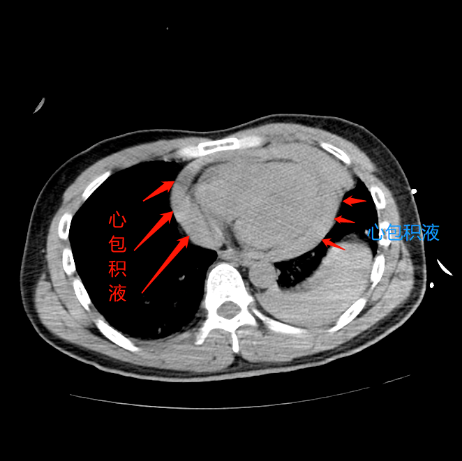 一方面完善ct检查  一方面通知胸心外科会诊 左侧胸腔积液,心包积液