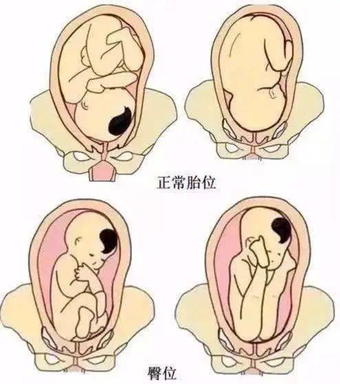 【医疗技术】胎儿臀位必须挨一刀?不不不,看这位产妇的顺产经历