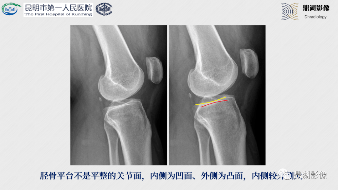 如何拍出完美的膝关节x线片?这些经验太重要了!