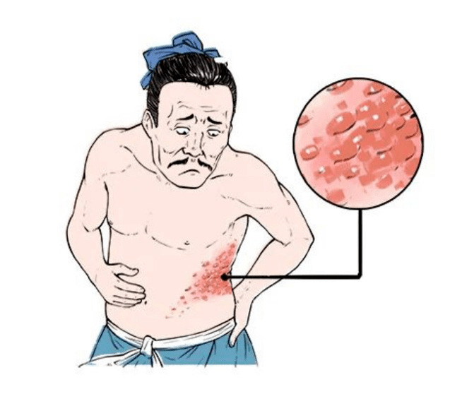 【金秋之声】中老年人为何容易患上带状疱疹?如何接种