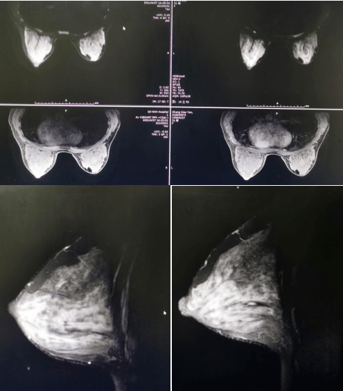 青海省第四人民医院可以做乳腺核磁共振啦