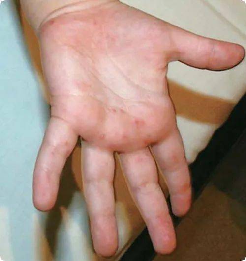 手足口病初期症状小孩手心 图片源于网络