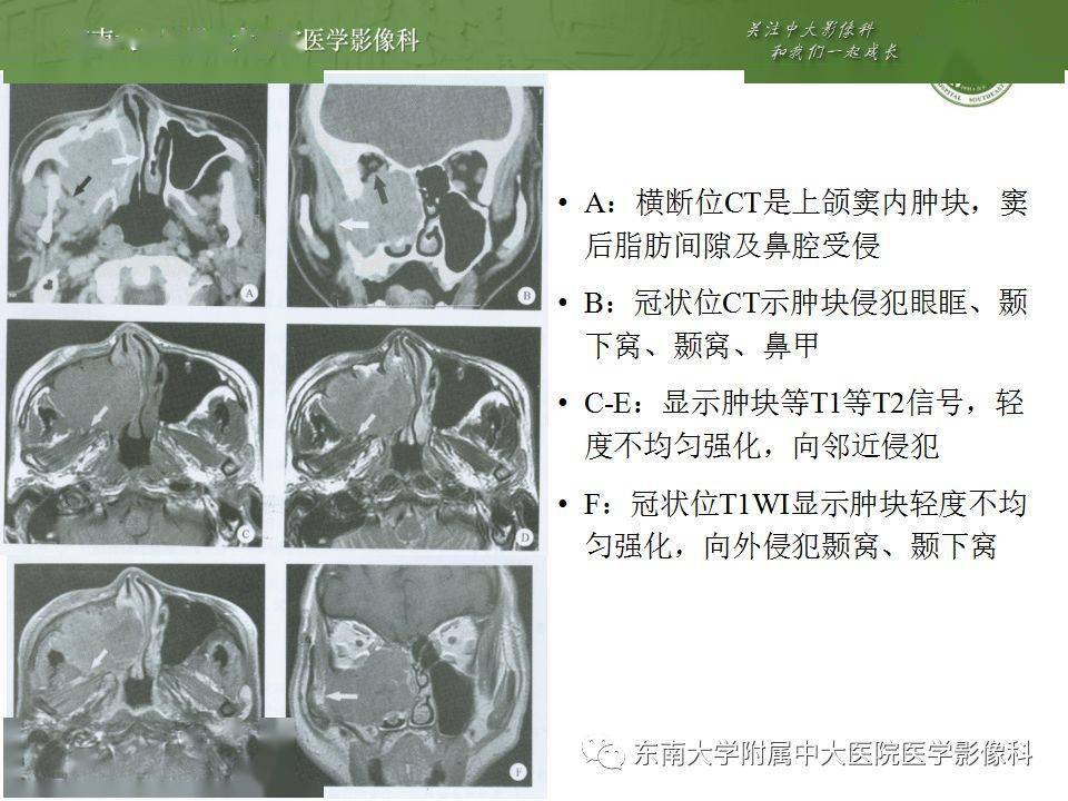 鼻窦解剖及真菌性鼻窦炎影像诊断与鉴别