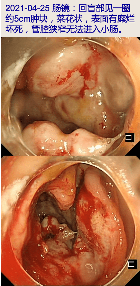 2021-04-25 肠镜:结肠镜检查至升结肠肠腔内暗红色液体; 回盲部见一
