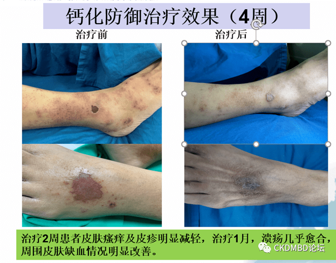 身陷"磷"圄危机四伏,多管齐下重见晴空—一位ckd-mbd患者合并钙化