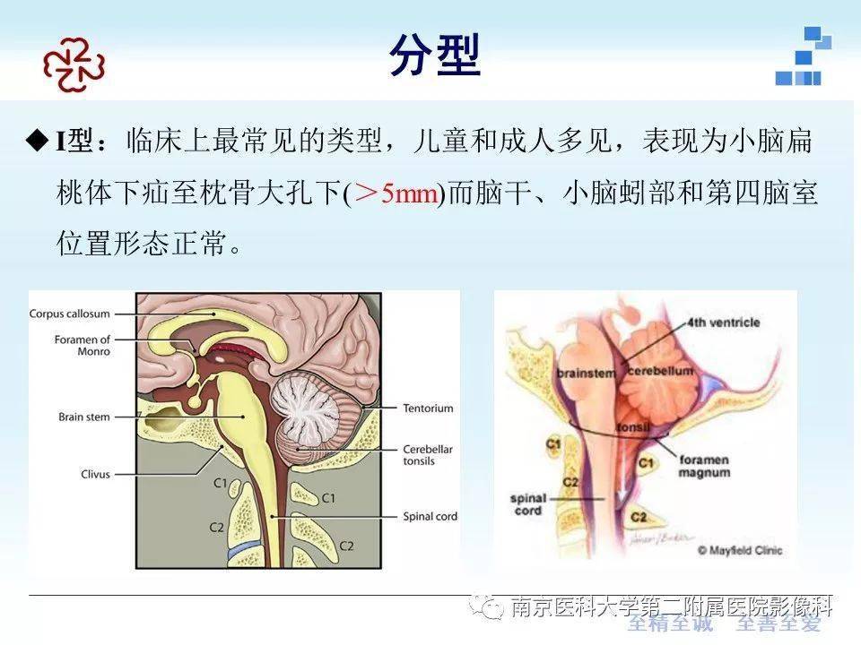 小脑扁桃体下疝畸形