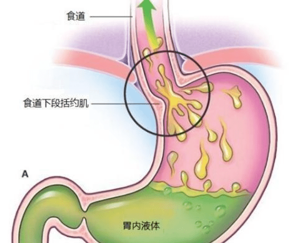 2,食物以软食,半流质为主,选择容易下咽的食物,避免误吸.