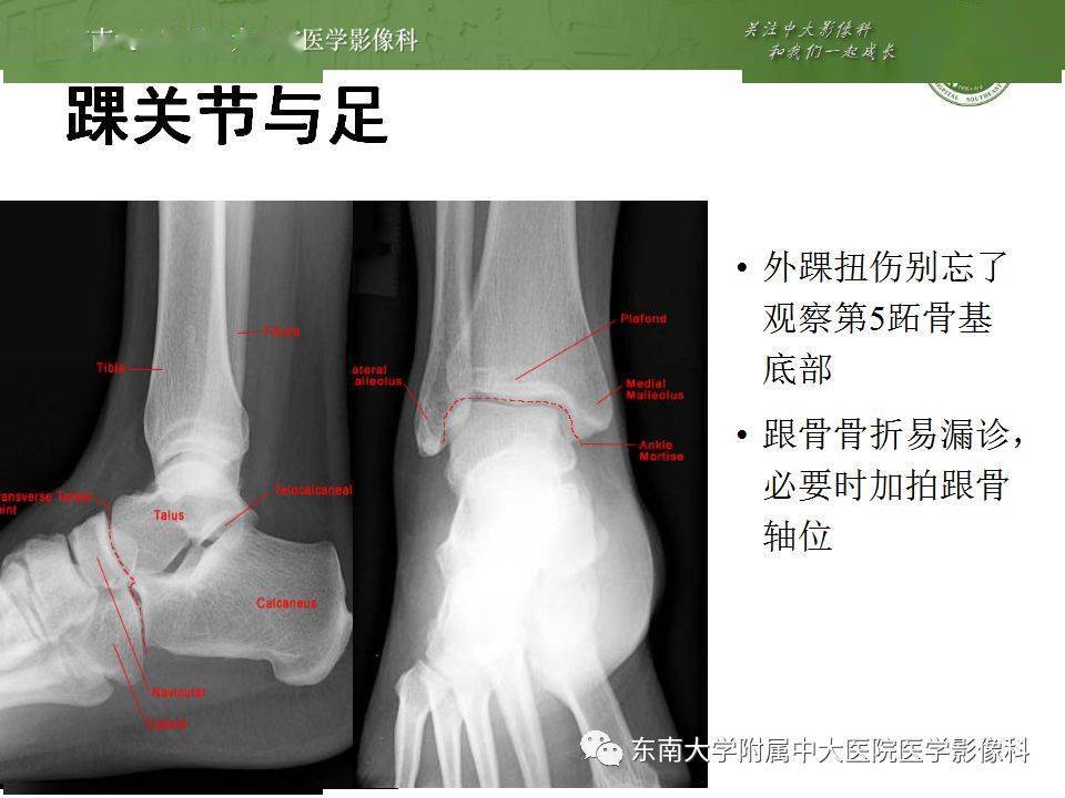 急诊22个四肢骨关节外伤x线易漏诊病例,建议收藏