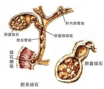 15岁男孩腹中取出100多颗胆结石带你看看什么原因