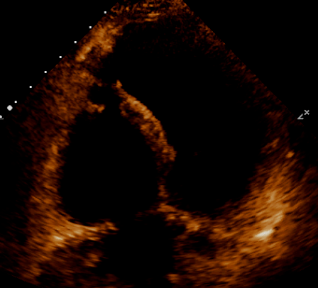 【病例分享】超声心动图诊断急性心肌梗死合并室间隔穿孔