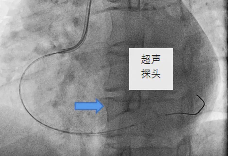 "无烟"造影以血管内超声对病人的冠脉进行检查,解决了以往造影剂过敏